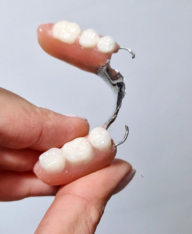 Proteză scheletată cu cârlige metalice — lucrare de tehnică dentară