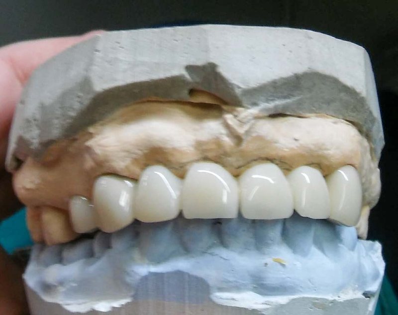Coroane ceramice montate pe model — lucrare de laborator