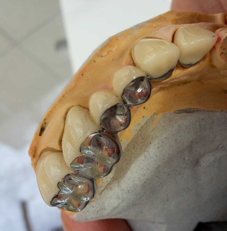 Punte metalo-ceramică pe model — lucrare de tehnică dentară